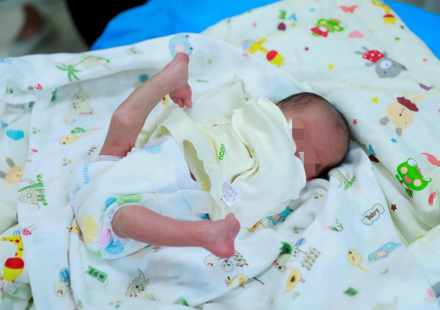 出生5天新生宝宝跨省千里来汉寻医，罕见反曲120°膝盖成功复位