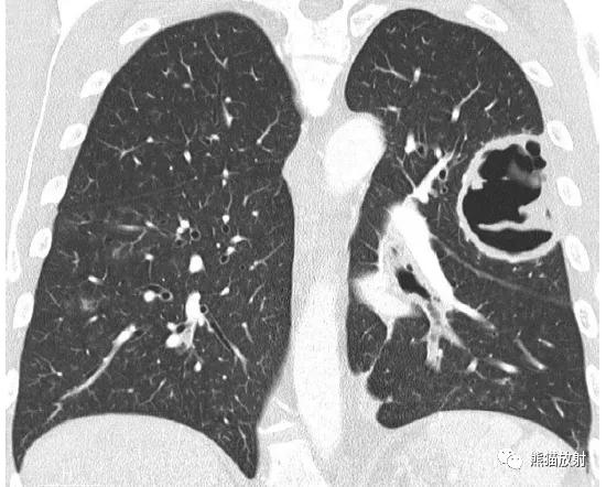 肺部感染并发症,老人新冠引起肺部并发症