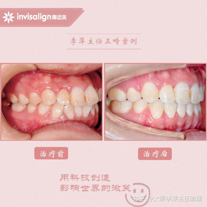 太原整牙齿矫正要多少钱,坏牙齿只剩牙根有必要拔牙吗