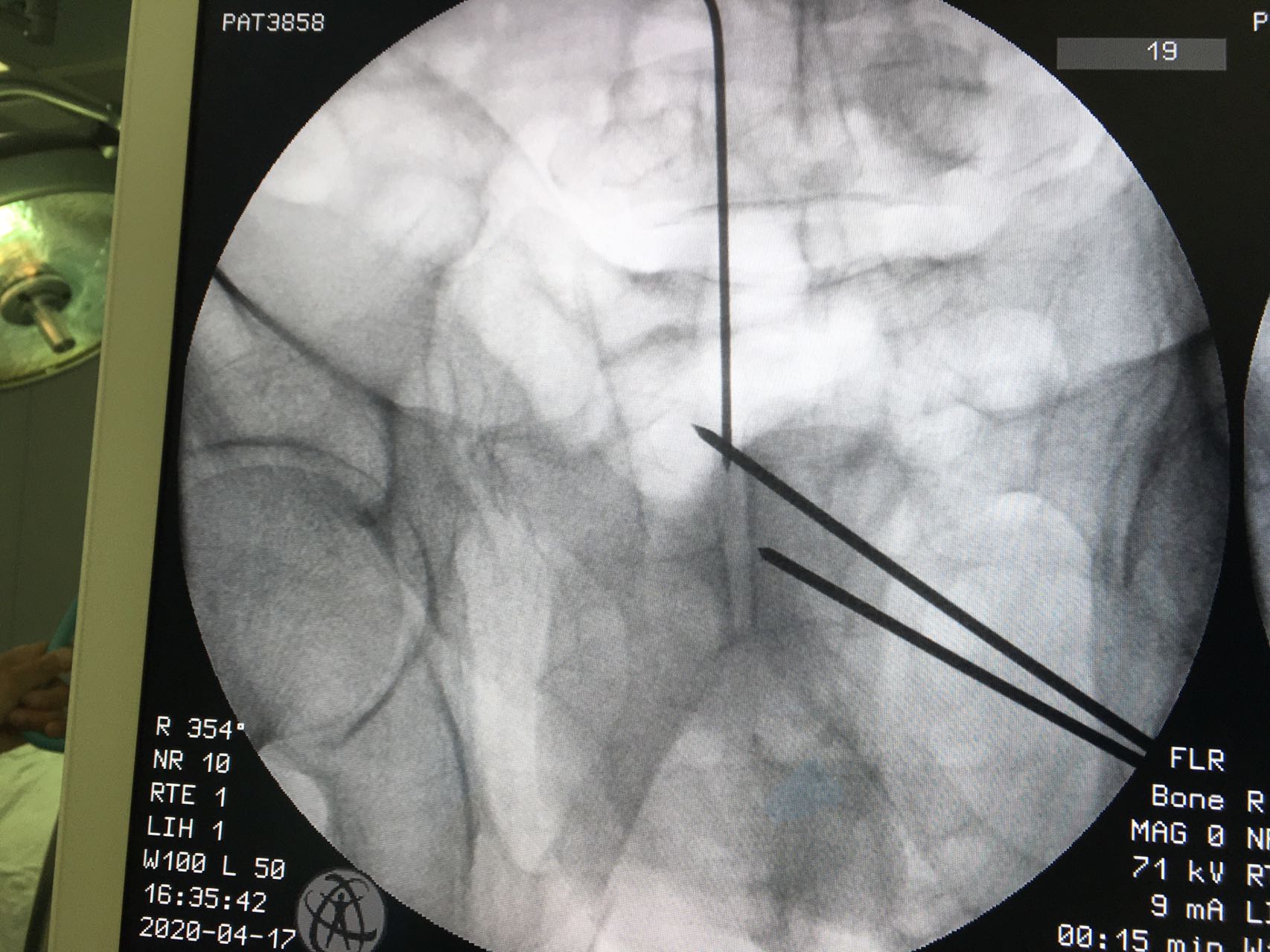 一名骨科医生股骨骨折经历,骨科朱医生
