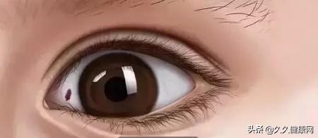 眼白上有黄斑会有什么后果,眼白有黑点是中邪了么