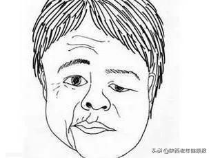 面肌痉挛康复手法,面肌痉挛康复胶囊