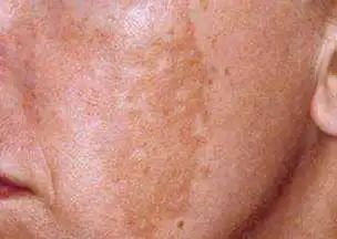 重要|雀斑和*褐斑黄**的注意事项