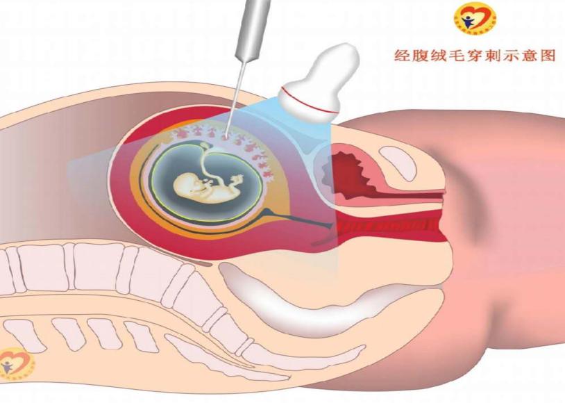 绒毛膜穿刺术——让你的产前诊断快人一步