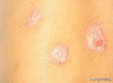 喝中药治疗荨麻疹反而严重了,防风能治荨麻疹吗