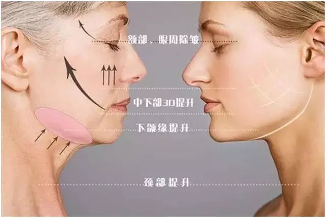 抗衰线雕面部提升多久做一次,无针线雕局部抗衰