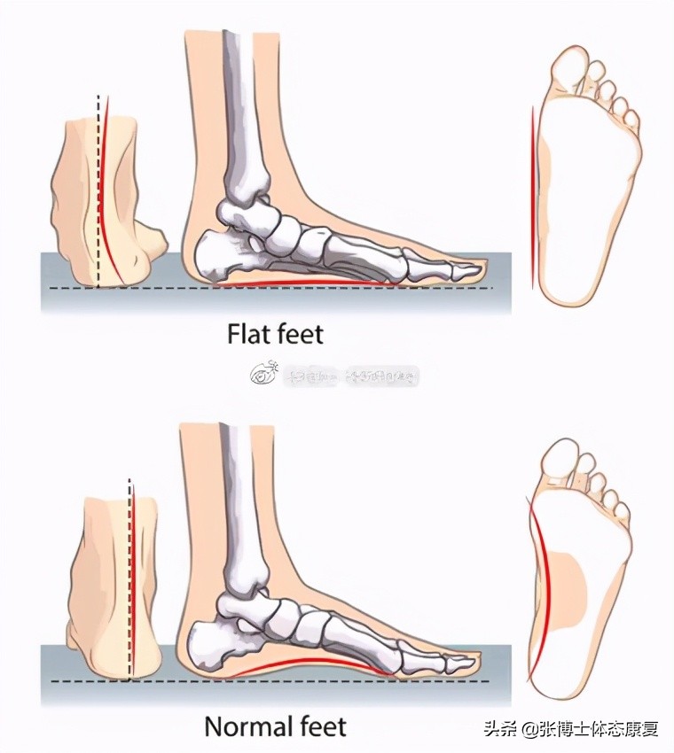 扁平足矫正的最佳年龄怎么矫正,扁平足的矫正方法舞蹈