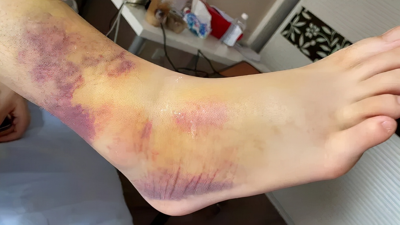 踝关节扭伤怎么判断骨头有没有伤,扭伤踝关节骨头移位去哪里治