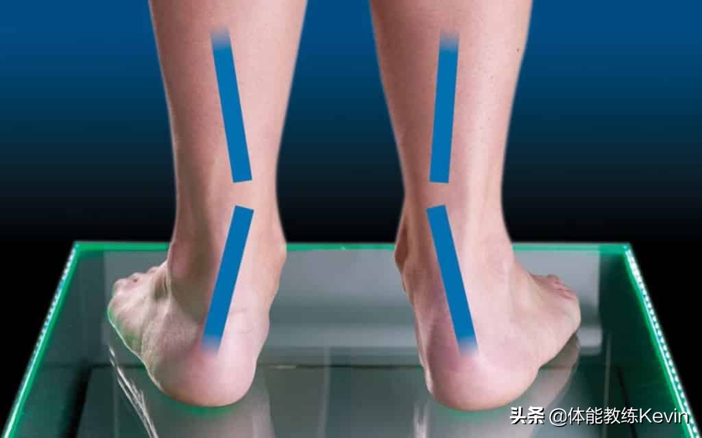 千里之行，始于“足下”——足外翻的5种解决方法