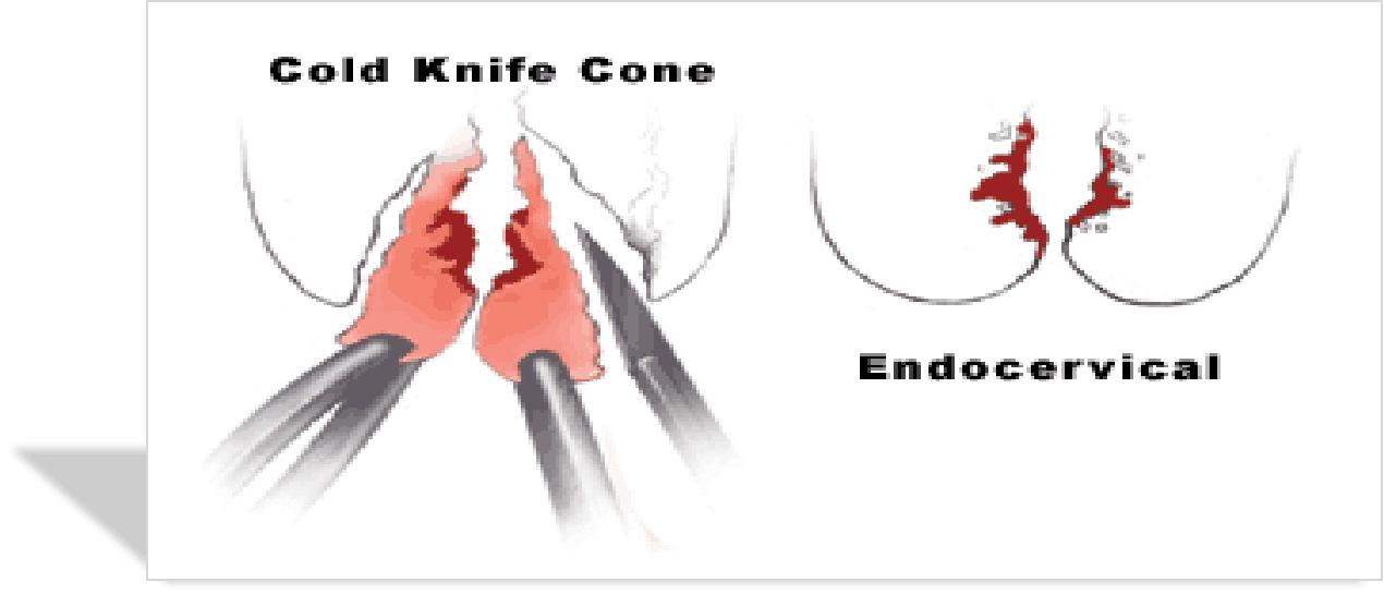 宫颈病变的诊断与治疗科普,宫颈低度病变如何治疗