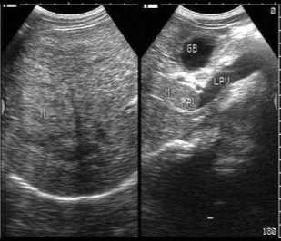 脂肪肝的防治与调养,脂肪肝的防治食物