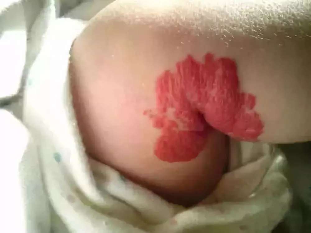 宝宝身上的胎记有问题吗,宝宝身上胎记很多是怎么回事