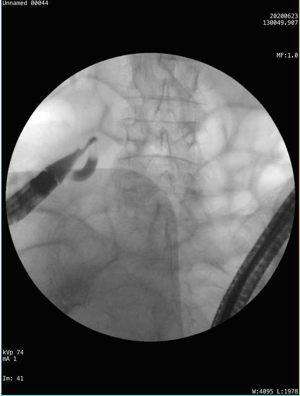 怎么让阑尾炎不复发,不开刀也能治愈阑尾炎