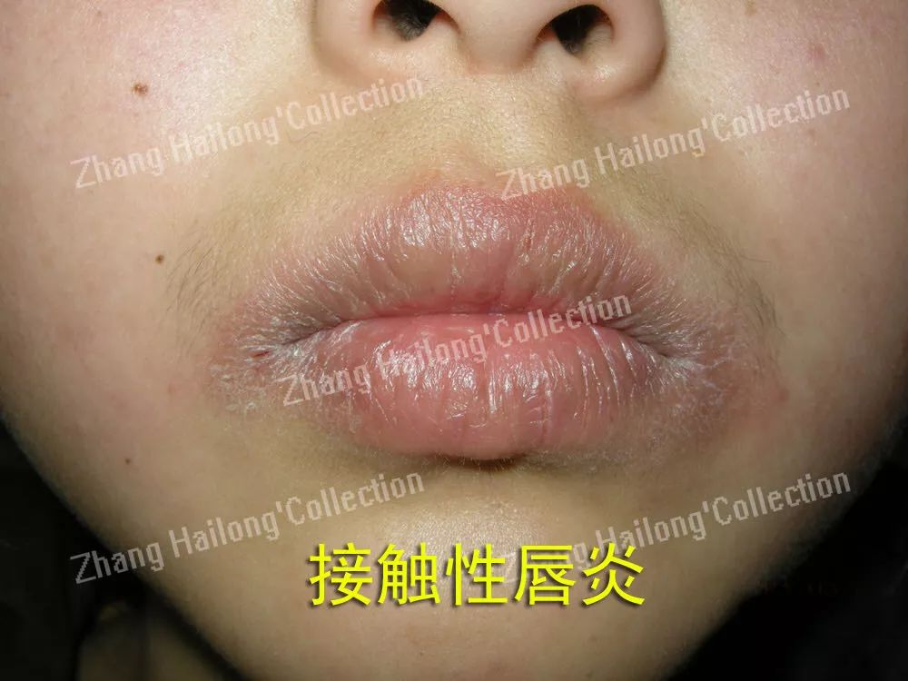 唇炎反复和口红有关系吗,都是红唇惹的祸