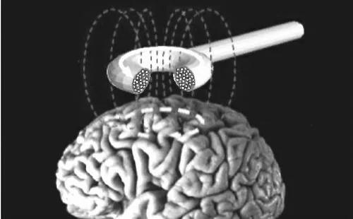骶神经刺激器植入术效果,全面开展神经调控技术