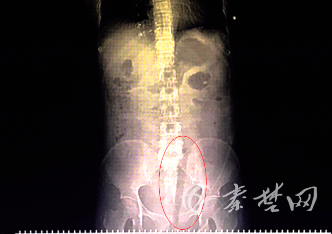 一女子摘樱桃时跌落30厘米长断枝插进下身直至腹腔！