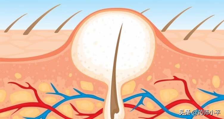 痘痘怎么预防与治疗,痘痘的形成原因专业知识
