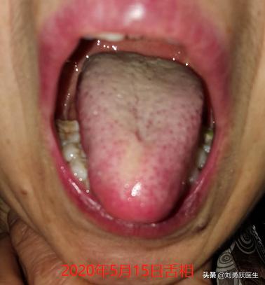 声带息肉和慢性咽炎吃什么药,声带息肉做手术后怎么调理