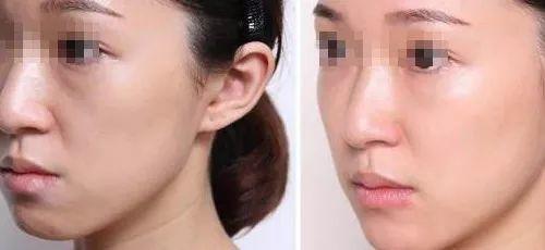 超声刀和热玛吉哪个提升效果好,超声刀和埋线提升哪个效果好