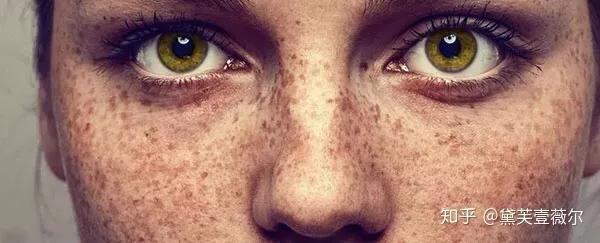 雀斑是什么原因引起的可以去掉吗,雀斑的形成原因及去除方法