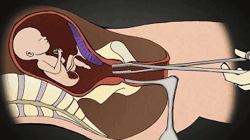 男用避孕药通过试验,网友:叫刘阳打针,半藏森林你不用吃药了