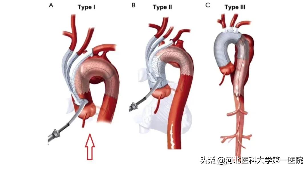 血管内再造血管？刀锋拆弹三开窗这种死亡率48小时达50%的疾病