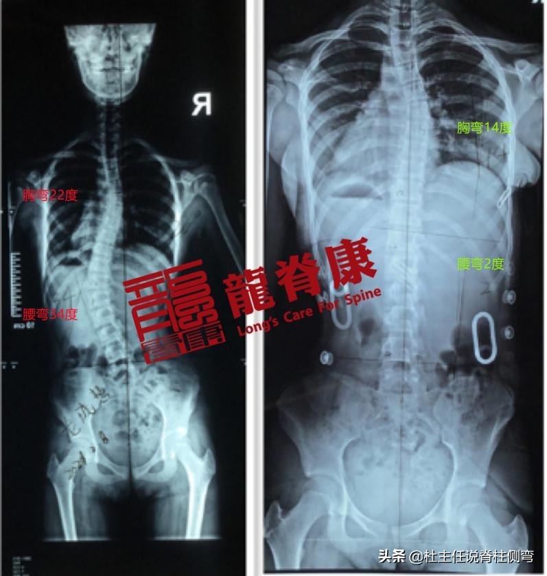 13岁女孩脊柱侧弯能治愈吗,13岁女孩脊柱侧弯21度还能矫正吗