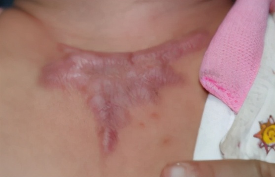 被火烫伤疤痕修复最好的方法,烧烫伤疤痕治疗的方法都有哪些