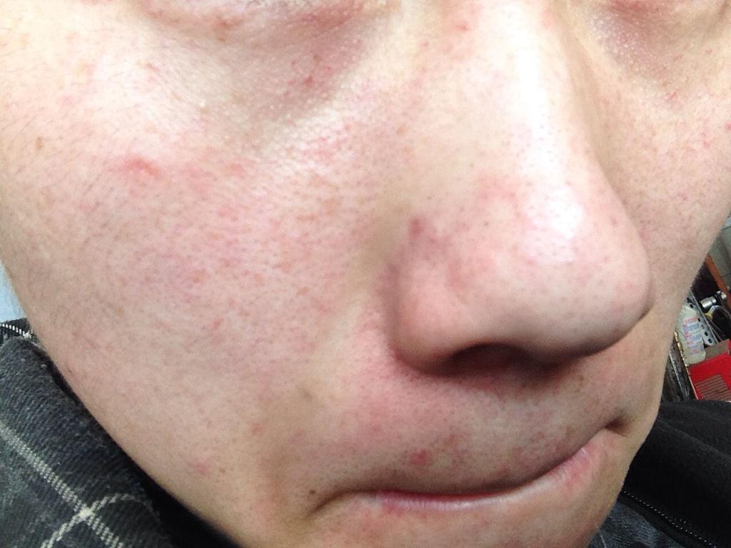 为什么脸上会有细小的血丝出现,为啥有的人脸部有红血丝呢