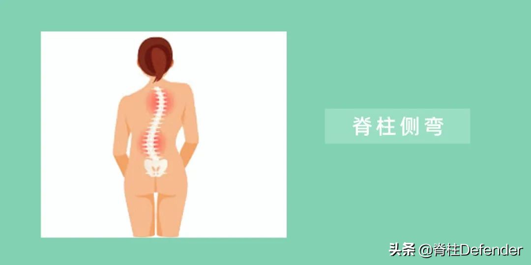 走路高低肩怎么矫正,高低肩怎么自我矫正