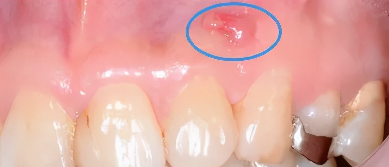 牙龈长脓包用针挑破又长脓包,牙龈肿了一个脓包要挤掉吗