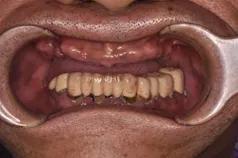 长沙牙齿种植的费用,长沙半口种植牙齿的过程