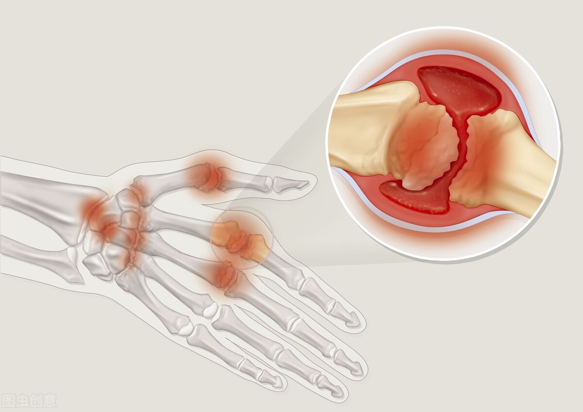 雷公藤治疗类风湿最好药,雷公藤是不是治风湿的