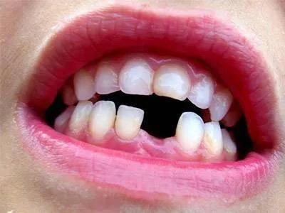 我的种植牙亲身经历,我的种牙经历感受