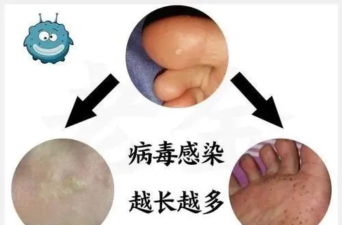 6岁儿童丝状疣怎么治疗,小孩子得寻常疣是什么原因造成的