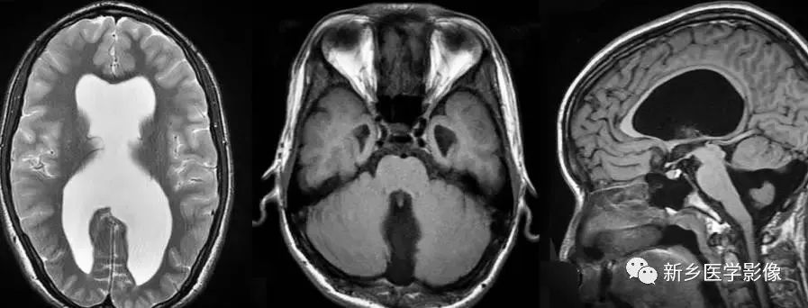 脑室影像学表现,脑室占位影像