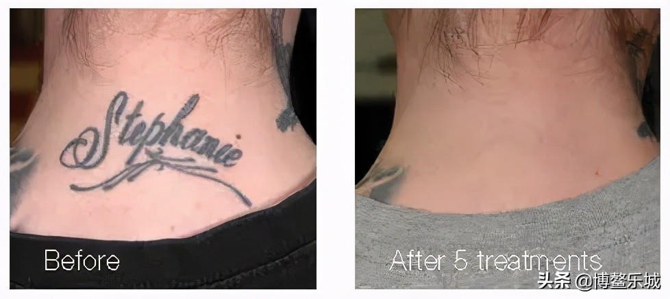 祛斑激光仪器评测,四合一otp激光祛斑仪