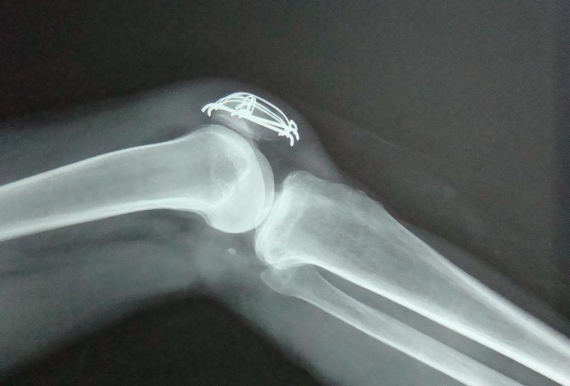 膝盖积水需要注意什么,怎么才能防止膝盖积水