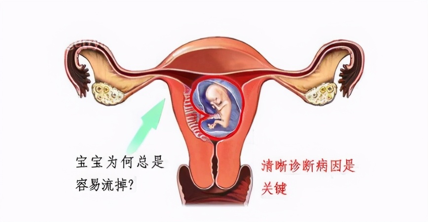 先兆流产,不都是孕酮低惹的祸