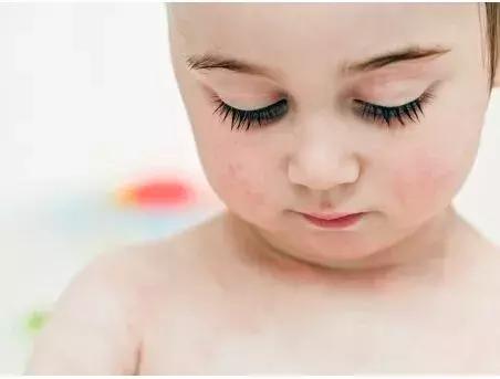 湿疹总是反复教你一招搞定它,湿疹太难缠了