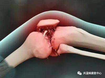 膝盖关节炎天冷了怎么就犯了,关节炎秋季