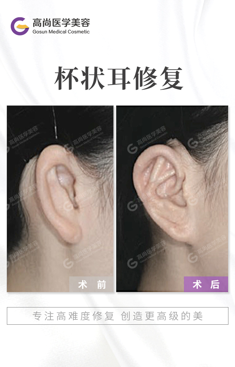 余文林耳再造失败案例,余文林耳畸形手术