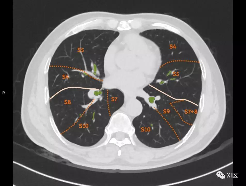 如此详细的肺部影像解剖，有点儿酷