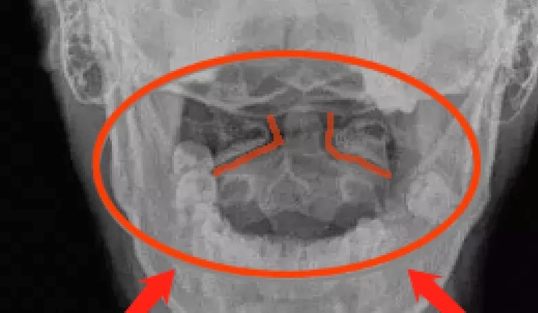 过敏性鼻炎变严重了,过敏性鼻炎导致体质变差