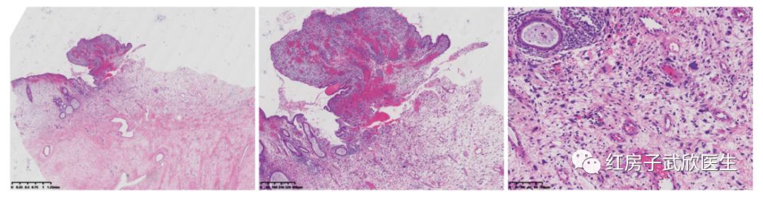 妇科胚胎性横纹肌肉瘤,宫颈早期胚胎性横纹肌肉瘤