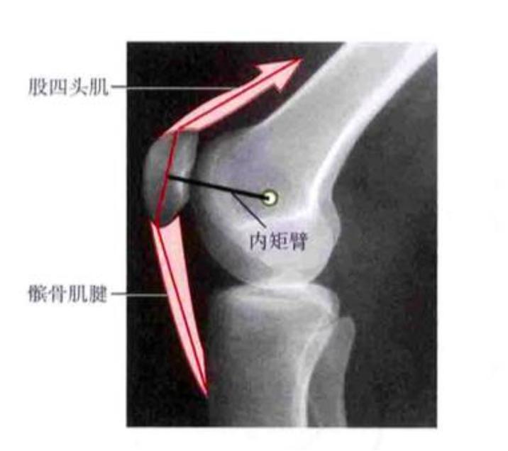 怎么查体判断髌骨软化,髌骨软化是发炎还是磨损