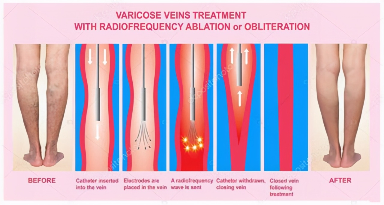 肝癌是如何确诊的？彩超能查出肝癌吗？听听专家怎么说