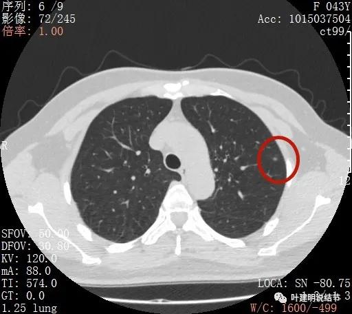 从活检怎么看是非小细胞癌,从病例谈辨证论治