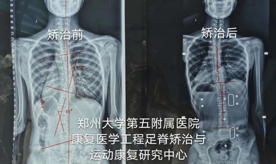少儿圆肩驼背改善,驼背骨科矫正