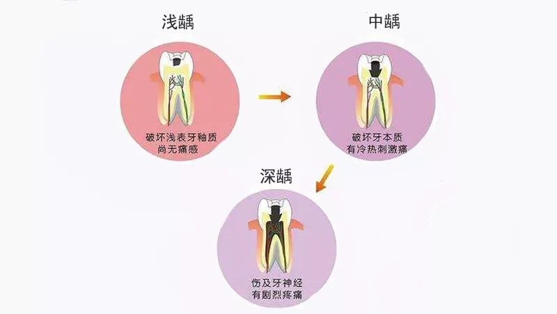 牙髓炎了不能继续再补牙吗,牙髓炎为什么不能自愈